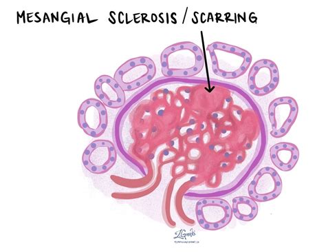 Diabetic nephropathy (diabetic glomerulosclerosis) | MyPathologyReport.ca