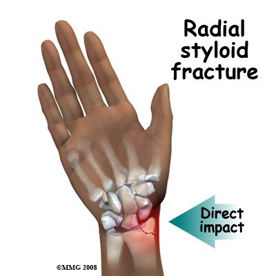 Radial Styloid Fracture Splint