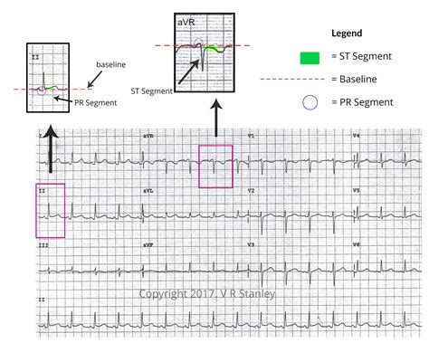 STEMI Mimic Series: 3 Cases of ST-Segment Elevation Differential Diagnosis - Dr. Stanley's ...