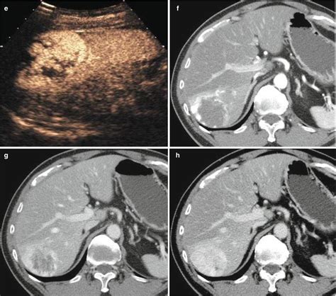 Liver Lesions On MRI