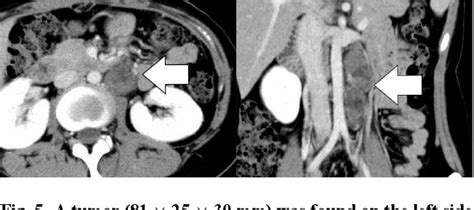 Figure 1 from Growing teratoma syndrome after surgery for ovarian ...