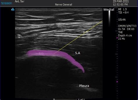 Ultrasound Guided Serratus Anterior Plane Block - RCEMLearning