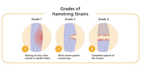 How to Treat a Pulled Hamstring | Sterosport