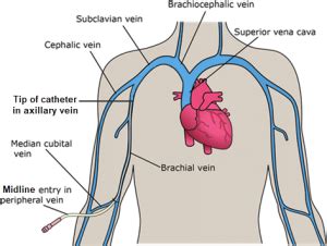 Can Midline Catheters Placed by Vascular Nurses Be Reported?