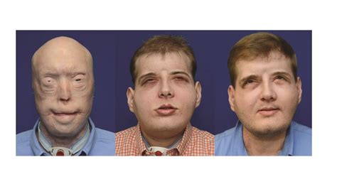 One Year On From Pioneering Face Transplant, Patient Says Surgery Has ...