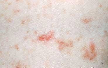 Scabies Infection The Mite Bite Dermatology Nurse Hom - vrogue.co