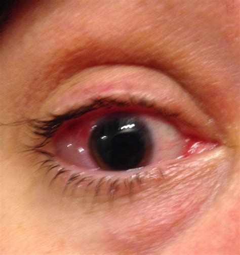 My eye after Avastin injection | Eyes, Ocular, My eyes