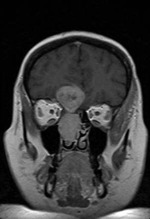 Olfactory neuroblastoma | Radiology Case | Radiopaedia.org