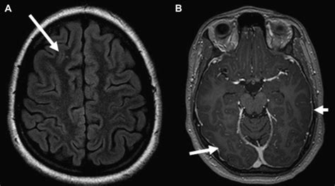 Anti–NMDA Receptor Encephalitis | Radiology Key