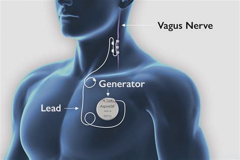 Vagus nerve stimulation - The Epilepsy Space