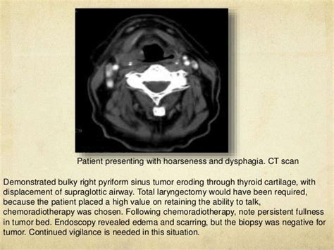 Hypopharyngeal cancer