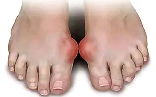 Gout: causes, symptoms and state-of-the-art treatments