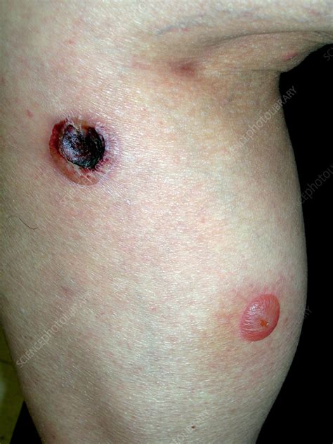 Bullous pemphigoid - Stock Image - C057/0562 - Science Photo Library