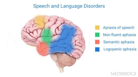 Primary Progressive Apraxia of Speech: Differential Diagnosis, Neurologic Underpinnings, and ...