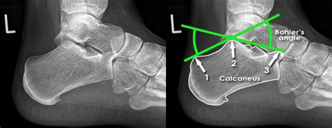 Trauma X-ray - Lower limb - Calcaneus