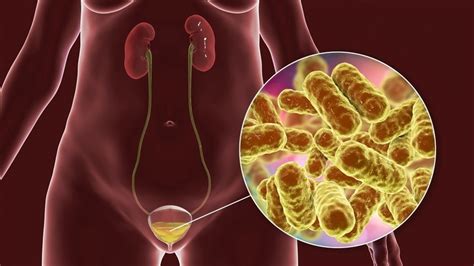 What is Chronic Cystitis?