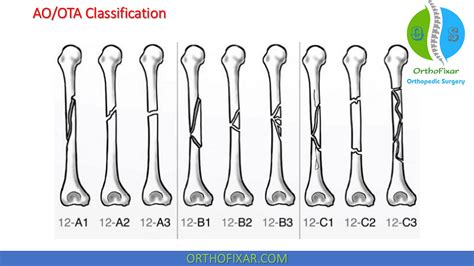 Types Of Splint For Humerus Fracture | motosdidac.es