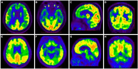 Frontiers | Missense mutation of angiotensin converting enzyme gene in an Alzheimer’s disease ...