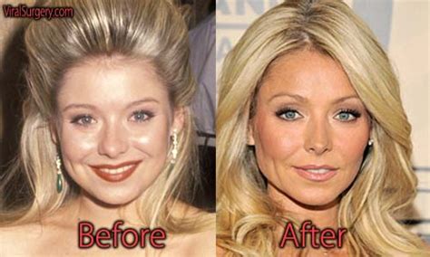 Kelly Ripa Plastic Surgery: Before and After Botox Pictures