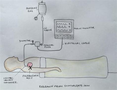 Central Venous Pressure (CVP)