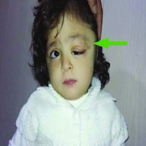 periorbital dermoid cyst in a toddler patient presented with a drooping ...