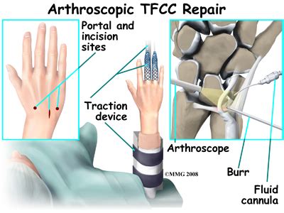 Triangular Fibrocartilage Complex (TFCC) Tears Wrist Conditions ...