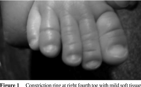 Figure 1 from Hair Tourniquet Syndrome in a Young Infant | Semantic Scholar