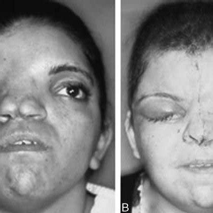 A 15 years old girl with hypertelorism associated with syndromic ...