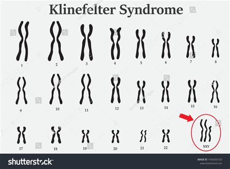 Karyotype of Klinefelter鈥檚 or XXY usually in male is born with an extra X chromosome (XXY). #Ad ...