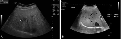 Sonography in surveillance for HCC in NAFLD patients