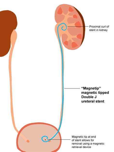 A brief history of ureteral stents