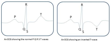 File:Schematic ECG normal and inverted T-wave.jpg - Embryology