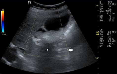 Diagnostic Point-of-Care Ultrasound (POCUS) for Abdominal Pain: A Case of Tumefactive Sludge ...