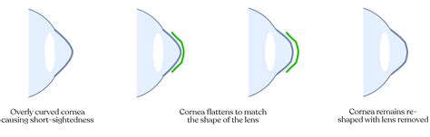 Ortho-k Lenses | Rancho Santa Margarita, CA | Kathleen Andersen, OD