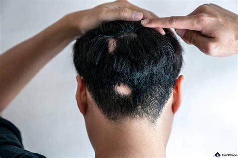 Alopecia Areata: Causes, Symptoms and How to Cope