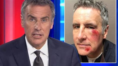 Newsreader Dermot Murnaghan shares picture of his bruised face after revealing he was in a hit ...