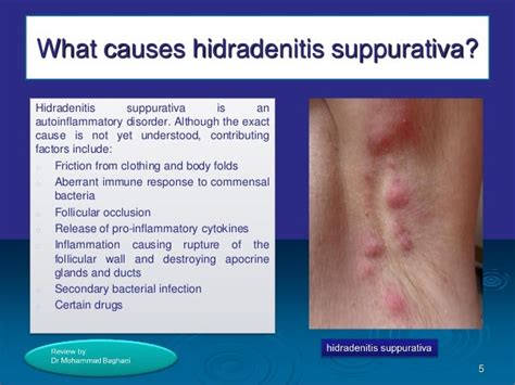 Hidradenitis suppurativa,by Dr Mohammad Baghaei