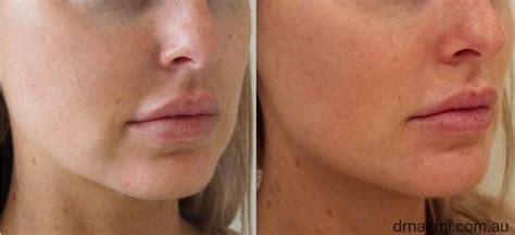 Jawline Filler: Experienced doctors at our Sydney clinic