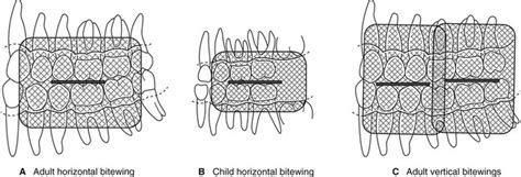 10: Bitewing radiography | Pocket Dentistry