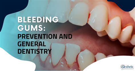 Bleeding Gums: Prevention and General Dentistry