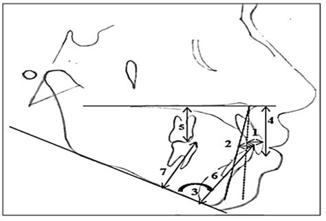 -Dental angular and linear measurements: 1. Upper incisor to point A,... | Download Scientific ...