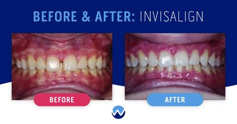 Clear Aligners Before & After: See How They Transform Smiles • Woodhill Dental Specialties