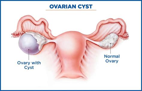 Laparoscopic ovarian cystectomy/ ovarian drilling