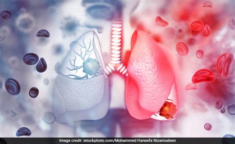 What Is White Lung Syndrome? A Mysterious Pneumonia Outbreak, Similar To China's - WebTimes