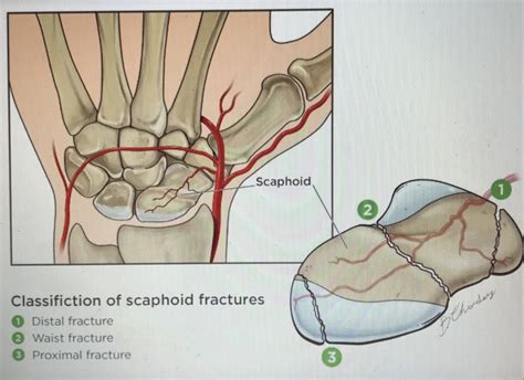 Scaphoid Fracture Without Treatment