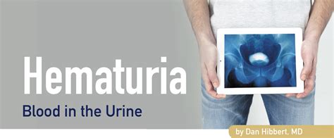 Hematuria | Northpointe Medical