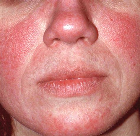 Rosacea: Expert recommends treating erythema, papules/pustules simultaneously | MDedge Internal ...