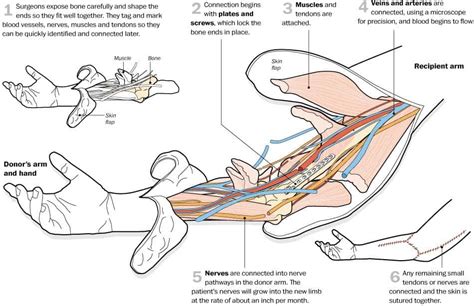 Doctors perform double-arm transplant on Iraq soldier