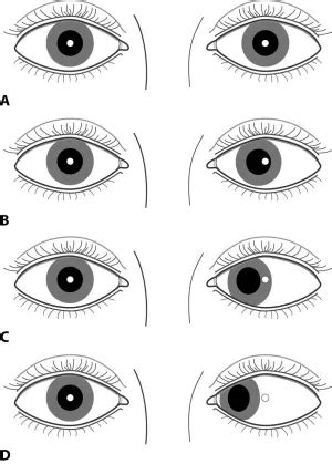 Hirschberg test - American Academy of Ophthalmology