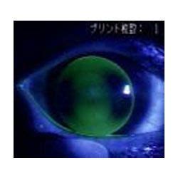 Keratoconus Lenses - Keratoconus Lens ( Customised) Manufacturer from ...